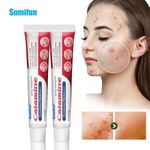 New 20g Rosacea Ointment Treat Red Nose Acne Cream Pimple Scar Repair Skin Care