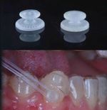 10-100Pis Dental Lingual Button Ceramic Buttons Clear Invisable Retainer Aligner