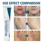Scars Remover Cream Clear Spots Burns Repairing 20g