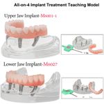 Dental Overdenture Implant All-on-4 Model Upper/Lower Jaw-Clear With 4 Screws