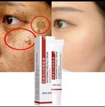 Whitening Freckles Spot Remover for Face Dark Spot Corrector-Hyperpigmentation