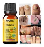 BEST Fungal Nail Treatment - Stops Toenail, Finger, Fungus Infections UK