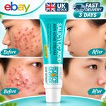 Salicylic Acid Strong Acne Removal Cream Anti Acne Pimple Scars Spots Clean Uk