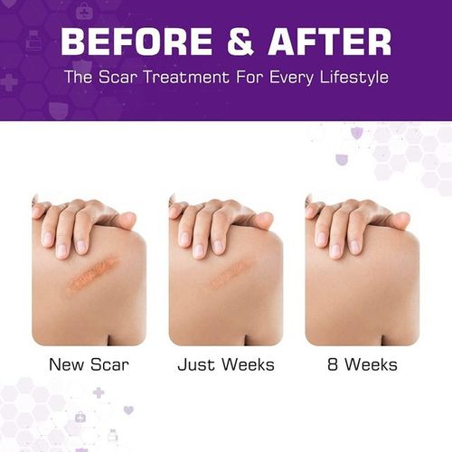 Silicone Scar Tape Plasters removal Kelinul Roll Reusable Sheets Medical grade — image 3