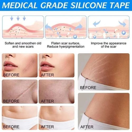 Silicone Scar Sheet MEDICAL GRADE Scar Removal Silicone Tape Treatment