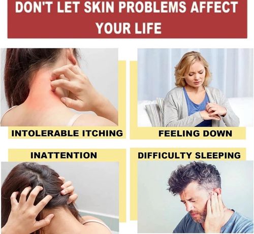 3pcs Antifungal Cream,Cream for Itchy Skin,Antifungal Cream for Skin,Itchy Skin — image 6