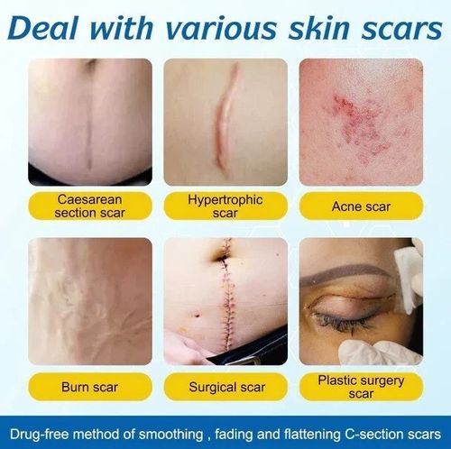 Silicone Scar Sheet MEDICAL GRADE Scar Removal Silicone Tape Treatment