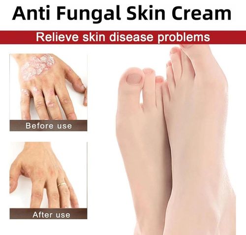 3pcs Antifungal Cream,Cream for Itchy Skin,Antifungal Cream for Skin,Itchy Skin — image 8