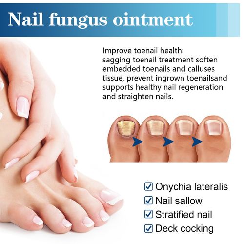 Nail Care Pen, 4Pcs Fungal Nail Pen, Nail Fungus Treatment for Toenail UK — image 17