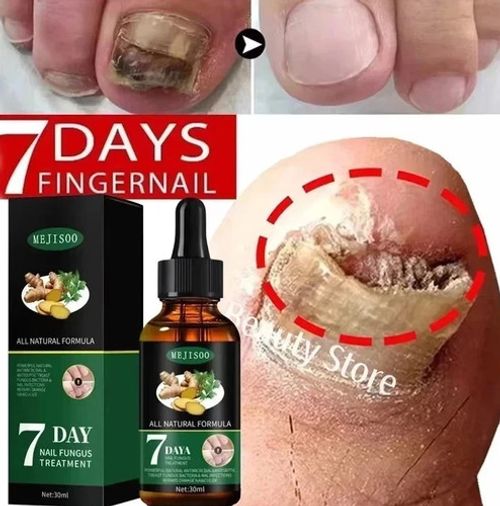 Fungal Nail Treatment Strong Fungus Remover Antifungal Liquid Serum Paronychia