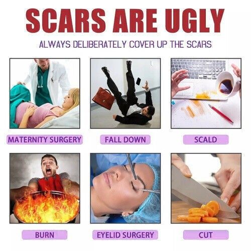 15gSilikongel zur Behandlung von alten und neuen Narben，Scar Treatment UK NEW — image 8