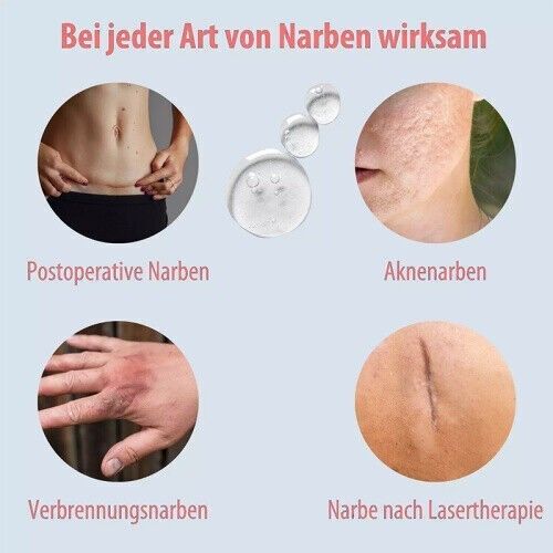 15gSilikongel zur Behandlung von alten und neuen Narben，Scar Treatment UK NEW — image 5