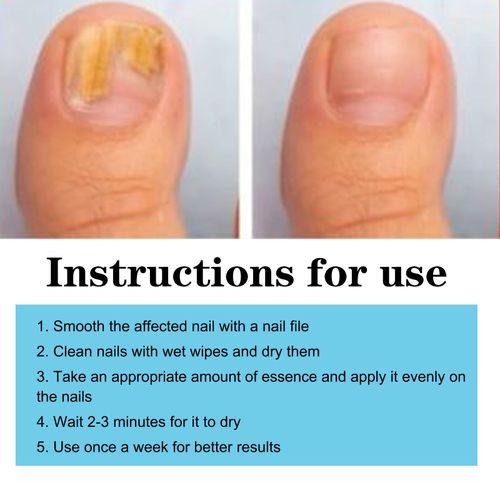 Nail Care Pen, 4Pcs Fungal Nail Pen, Nail Fungus Treatment for Toenail UK — image 9