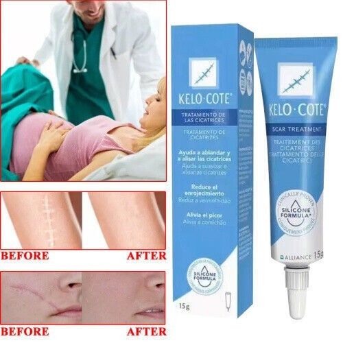 15gSilikongel zur Behandlung von alten und neuen Narben，Scar Treatment UK NEW — image 3