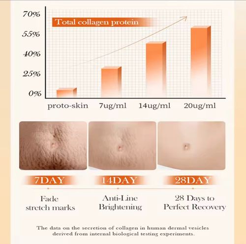 stretch- marks removal cream Skin Repair Pregnancy Belly Spots Removal Cream — image 4