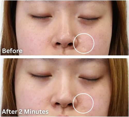 Dermaflage Topical Scar Filler Single Refill Applicator (Light) - Hollywood Sil — image 5