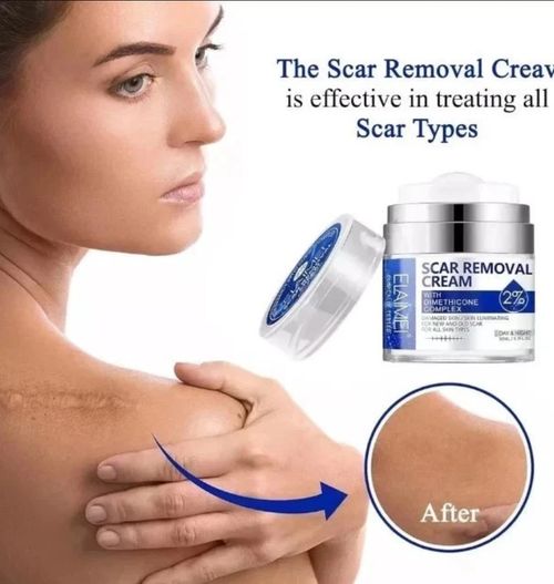 Scar Removal Cream 50ml 2% Dimethicone for Acne Scar Stretch Marks & skin repair — image 3