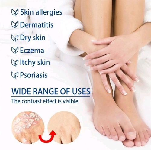 Psoriasis Dermatitis Eczema NATURAL Skin Treatment BALM CREAM OINTMENT 30g 🇬🇧  — image 7