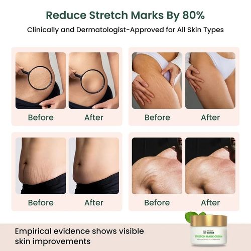 Healofy Naturals Stretch Marks Cream For Hydrates Skin 100gm