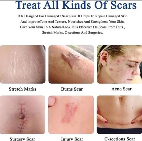 Scar Removal Cream 50ml 2% Dimethicone for Acne Scar Stretch Marks & skin repair — image 2