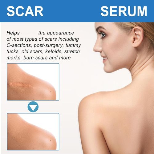 Silicone Scar Gel - 50ml Cream for Effective Scar Removal & Skin Soothing — image 5