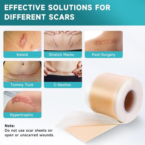 Waterproof Reusable Silicone Scar Tape Breathable Skin Friendly Adhesive Strips — image 2