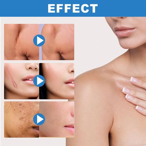 Silicone Scar Gel - 50ml Cream for Effective Scar Removal & Skin Soothing — image 2