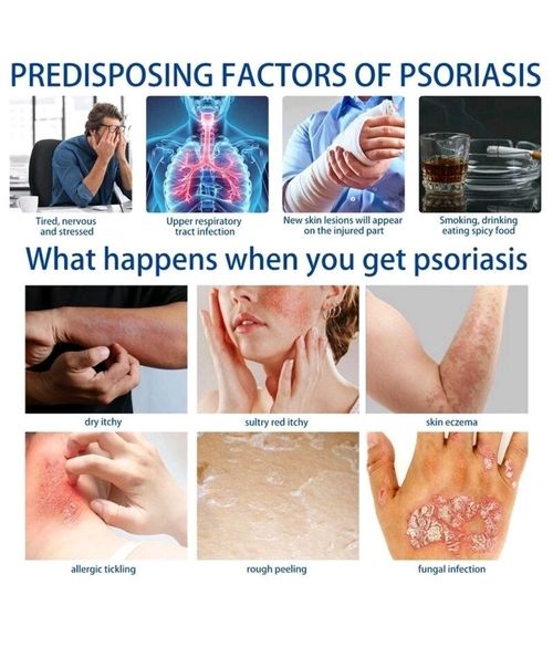 Psoriasis Dermatitis Eczema NATURAL Skin Treatment BALM CREAM OINTMENT 30g 🇬🇧  — image 4