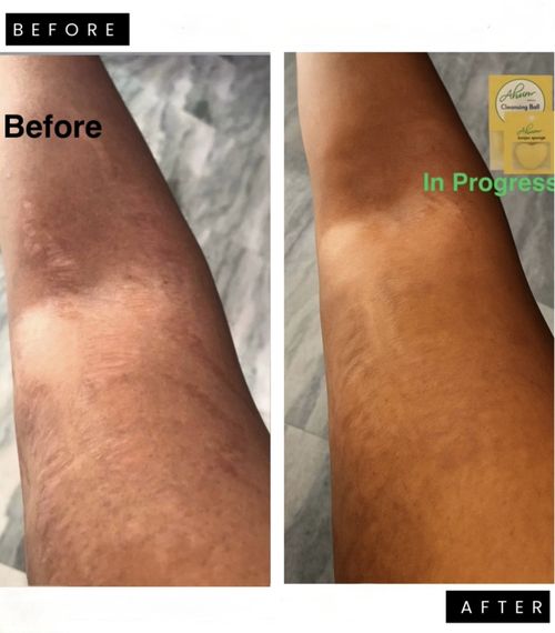 Ahum Stretch Marks 2 Oils, Soap & Sponge Fade Stretch Marks moisturize Naturaly