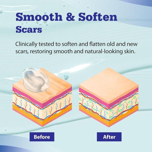 Dermatix Ultra Silicone Scar Gel – Advanced Scar Treatment 15gram UK