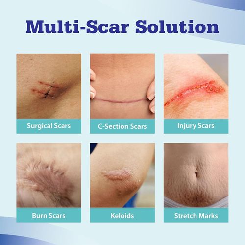 Dermatix Ultra Silicone Scar Gel – Advanced Scar Treatment 15gram UK