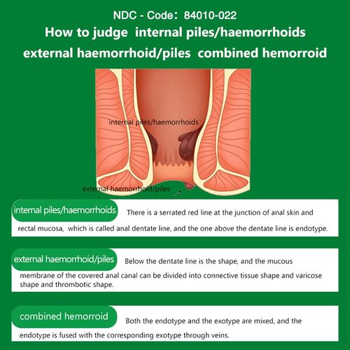 Hemorrhoid Cream Haemorrhoids Fissure Gel Piles Anal Fissure Prolapse Ointment — image 6