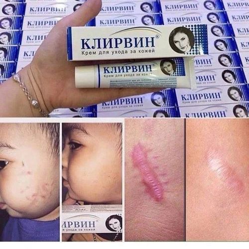 2x KLIRVIN Skin Care Cream 25g for Acne Marks Scars & Stretch Marks — image 2