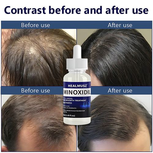 10 Month Supply Men Women Hair Regrowth Treatment Extra Strength Solution 50ml — image 4