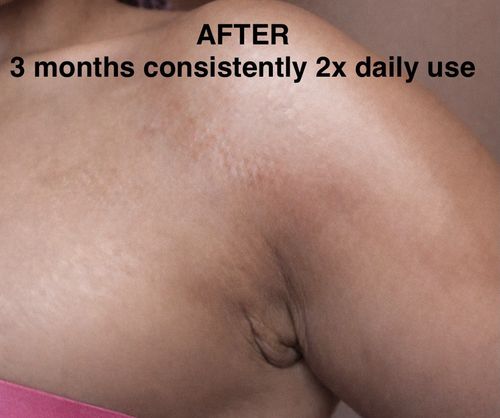 Ahum Stretch Marks 2 Oils, Soap & Sponge Fade Stretch Marks moisturize Naturaly