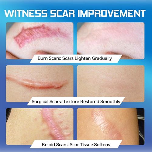 Dermatix Ultra Silicone Scar Gel – Advanced Scar Treatment 15gram UK