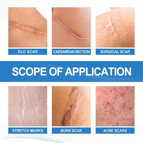 Silicone Scar Gel - 50ml Cream for Effective Scar Removal & Skin Soothing — image 3