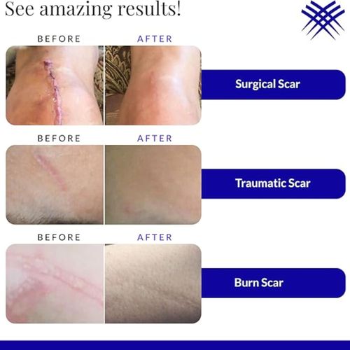 Rejuvaskin Scar Esthetique Scar Cream with Silicone 60mL Softens Brightens Scars — image 4