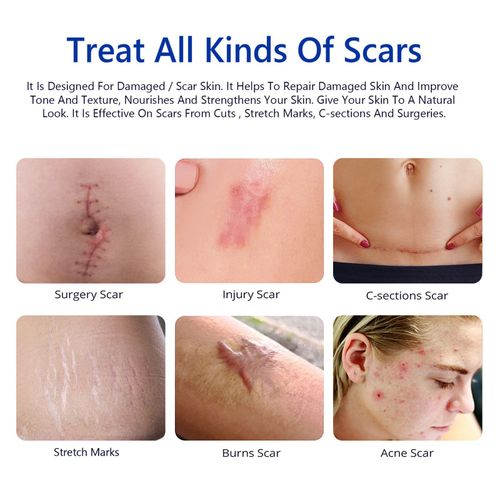 Scar Removal Cream - Rapid Repair of New & Old Scars, Acne Spots, Burns — image 9