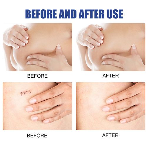 Silicone Scar Sheets for Breast Scar Removal Sheets Areola Strips Anchor Sheets — image 6