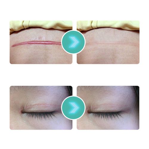 Scars Skin UV Protection Portable Breathable Scar Strips Women Hyperplastic NEW — image 23