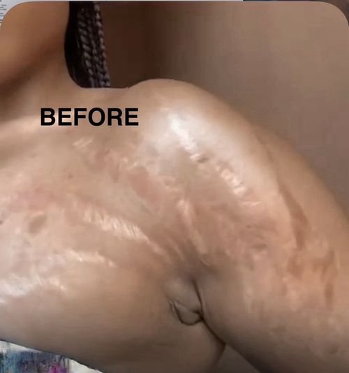 Ahum Stretch Marks 2 Oils, Soap & Sponge Fade Stretch Marks moisturize Naturaly