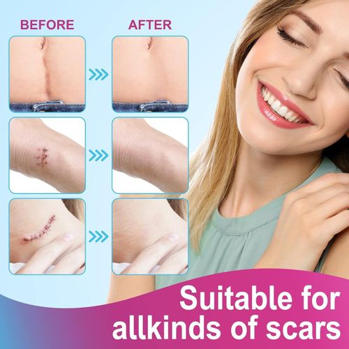 VOGSIG Silicone Scar Sheets Size 1.6"X75" Ultra-Thin Breathable & Waterproof — image 5