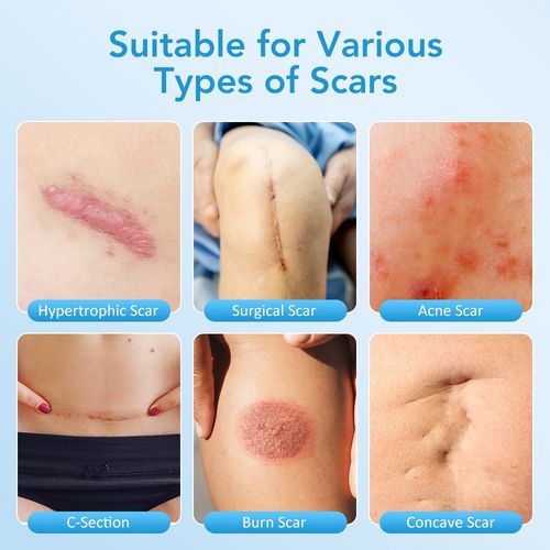 150cm Silicone Scar Tape Scar Sheets Tape Roll For Sensitive Skin Face Wrinkle — image 11