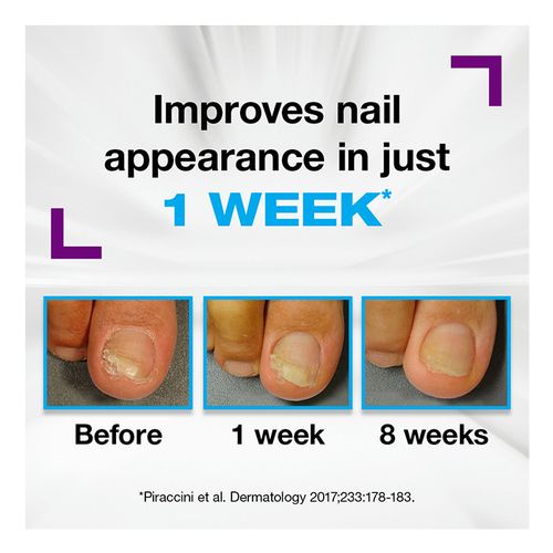 x3 Emtrix Fungal Nail Treatment Extra Strong Fungus Remover Antifungal Pen 10ml — image 3