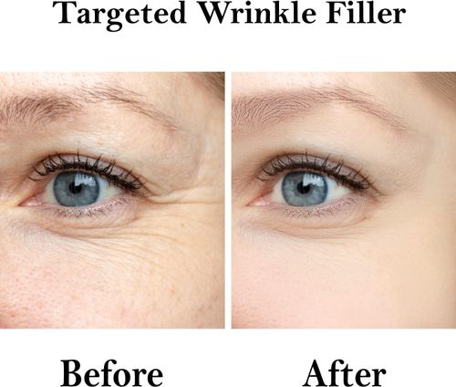 Wrinkle Filler that Works with Hyaluronic Acid ( 15ml) — image 4