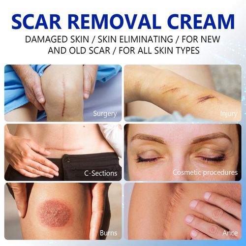 Scar Removal Cream - Rapid Repair of New & Old Scars, Acne Spots, Burns — image 11