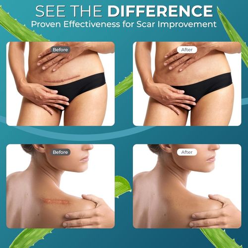 Medical Grade Silicone Scar Tape Aloe Vera 4cm x 1.2M Soft & Discreet — image 8