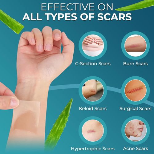 Medical Grade Silicone Scar Tape Aloe Vera 4cm x 1.2M Soft & Discreet — image 7