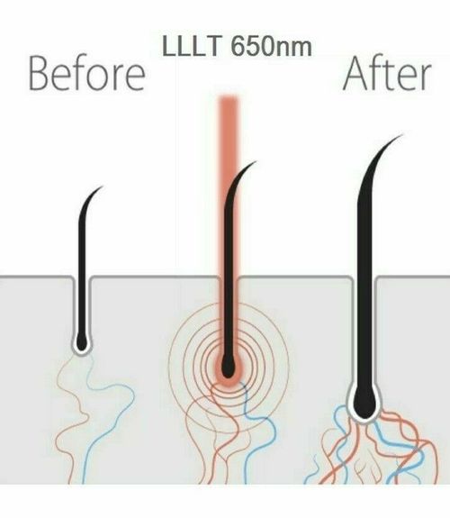Newest Hair Regrowth Laser Therapy Cap 81 Diodes LLLT Helmet Hair Loss Treatment — image 5